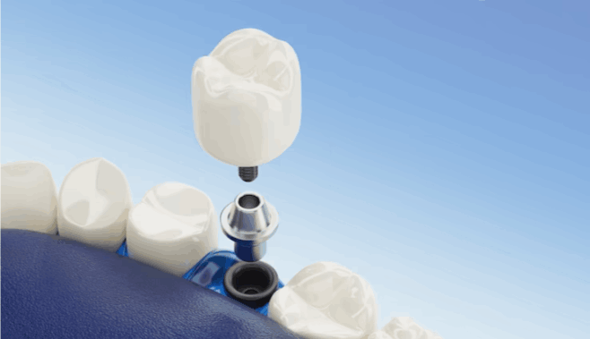 clearchoice dental implants